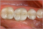 Tooth Colored Fillings After