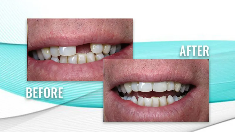 Before and after: a patient's smile with a missing upper front tooth, then a complete row of upper teeth