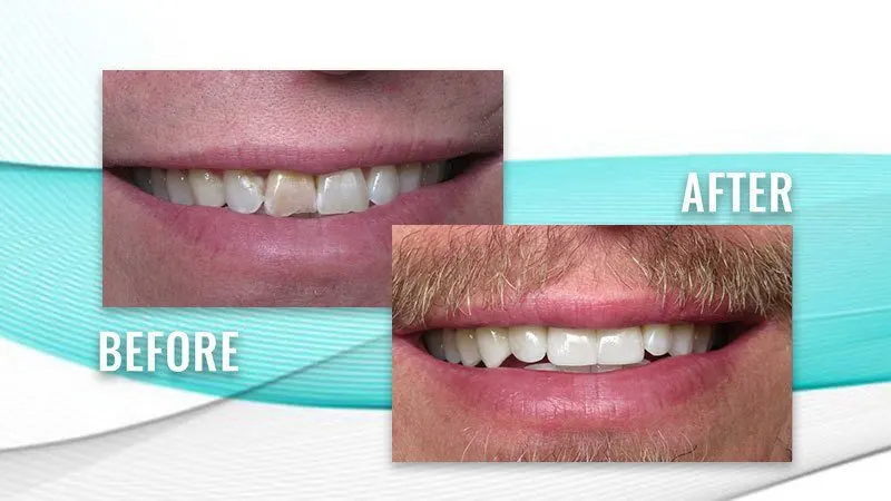 Before and after: a patient's smile with a discolored upper front tooth, then evenly matched upper front teeth