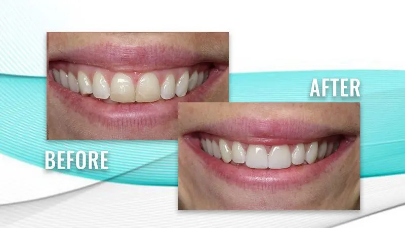 Before and after: a patient's smile with uneven, yellowed front teeth, then brighter, more uniform front teeth