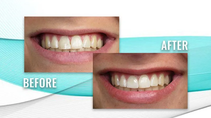 Before and after: a patient's smile with a darker upper front tooth, then front teeth that match in color