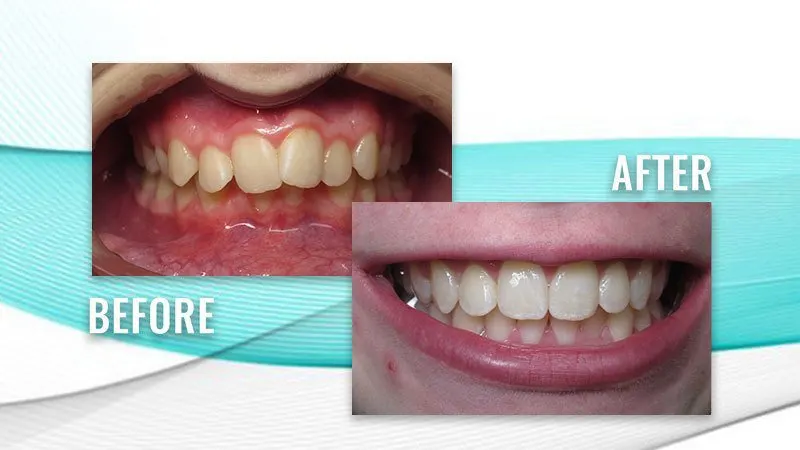 Before and after: crowded, uneven upper teeth, then straight, aligned teeth in a smile