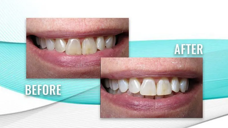 Before and after: a patient's smile with yellowed front teeth, then lighter front teeth