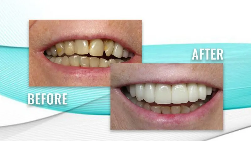 Before and after: a patient's smile with worn, yellowed teeth, then a full row of white, even upper teeth