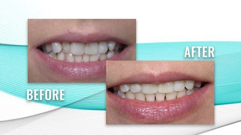 Before and after: a patient's smile with slightly uneven front teeth, then a more even smile
