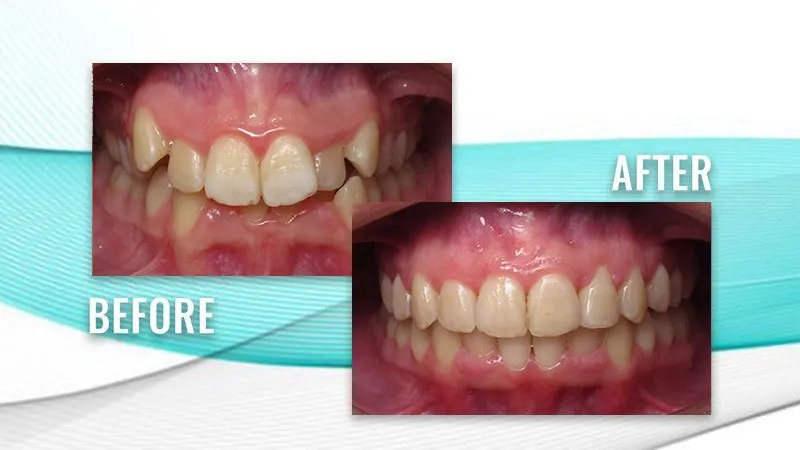 Before and after: crowded upper teeth with high canines, then straight, aligned upper teeth