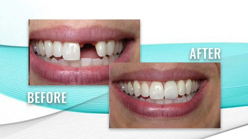 Before and after: a patient's smile with a missing upper front tooth, then a complete, even smile