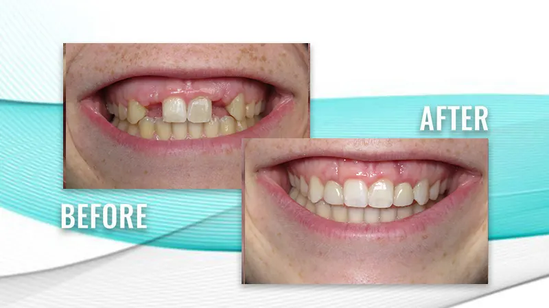 Before and after: a patient's smile with gaps from missing upper teeth, then a complete row of upper teeth