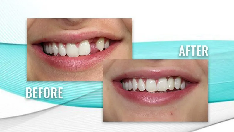 Before and after: a patient's smile with a missing upper tooth, then a complete row of upper teeth