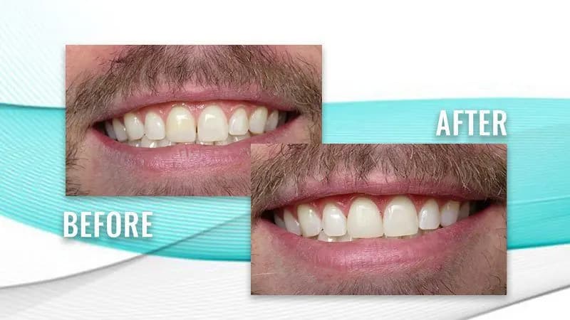 Before and after: a patient's smile with small gaps between the front teeth, then even front teeth with the gaps closed