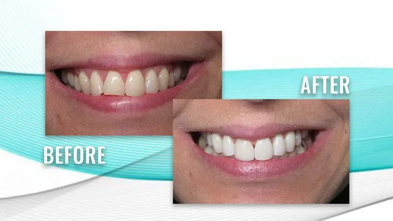 Before and after: a patient's smile with uneven, discolored front teeth, then whiter, more even teeth