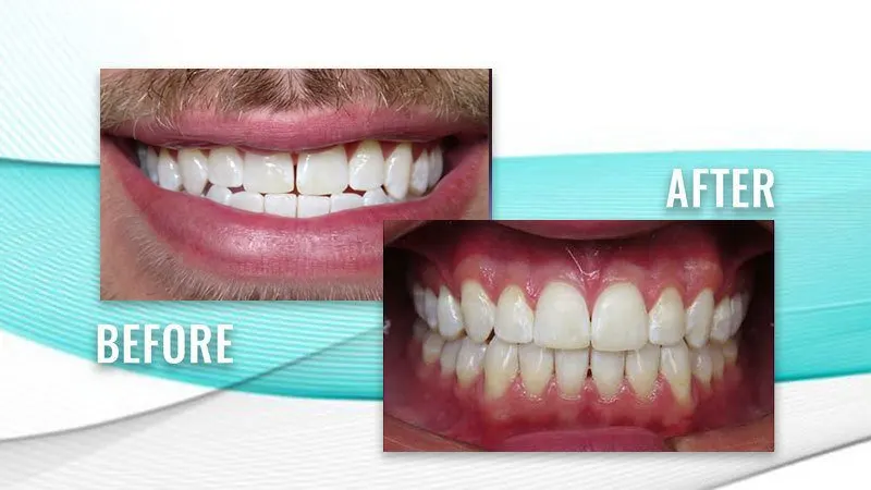 Before and after: a patient's smile with slightly uneven front teeth, then straight, aligned teeth
