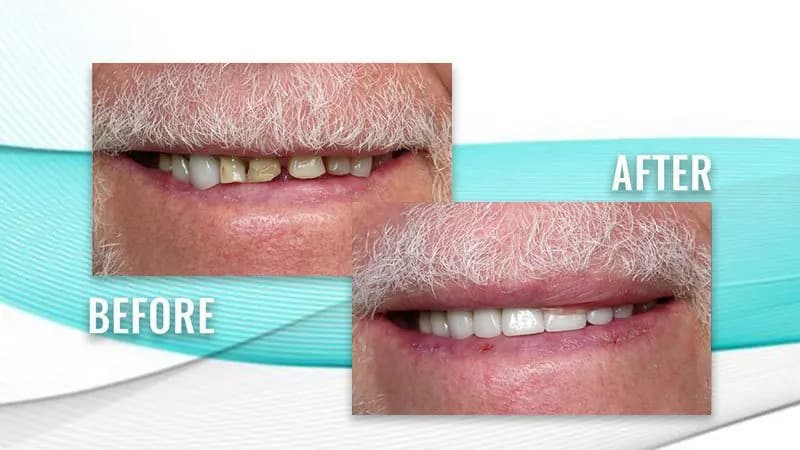 Before and after: a patient's smile with worn, discolored front teeth, then even, white front teeth