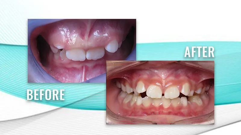 Before and after: a child's narrow, crowded upper teeth, then a wider upper arch with more room
