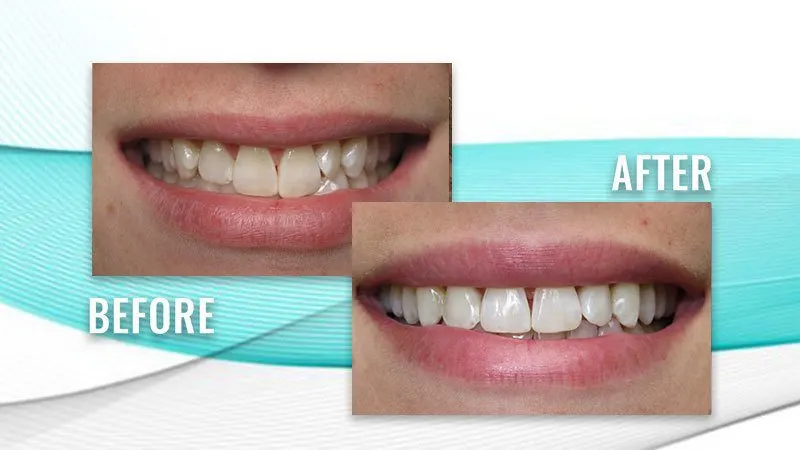 Before and after: a patient's smile with overlapping front teeth, then straighter front teeth