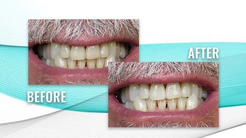Before and after: a patient's smile with yellowed teeth, then lighter teeth