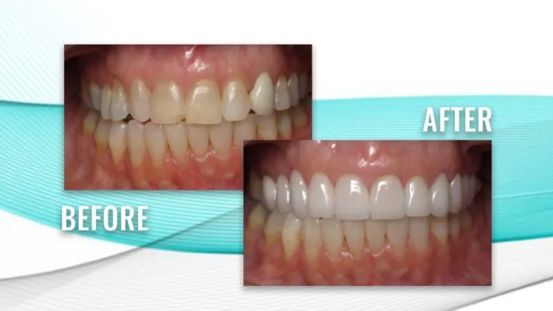 Before and after: a row of discolored upper teeth, then a bright, uniform upper row