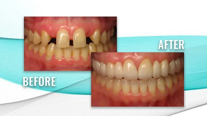 Before and after: upper teeth with wide gaps beside the front teeth, then a full, even upper row