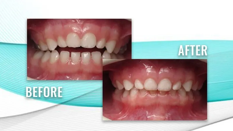 Before and after: a child's crowded teeth with an open bite, then more evenly spaced teeth