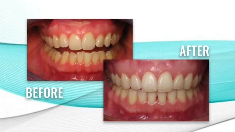 Before and after: uneven upper and lower teeth, then straighter, aligned teeth