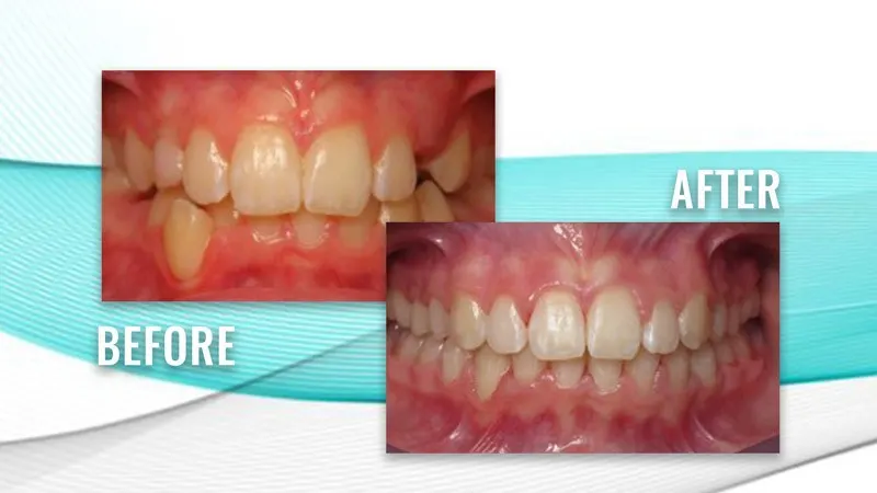 Before and after: crowded, overlapping teeth, then straight, aligned teeth