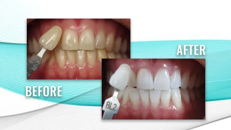 Before and after: teeth beside a darker shade guide tab, then whiter teeth beside a lighter shade guide tab