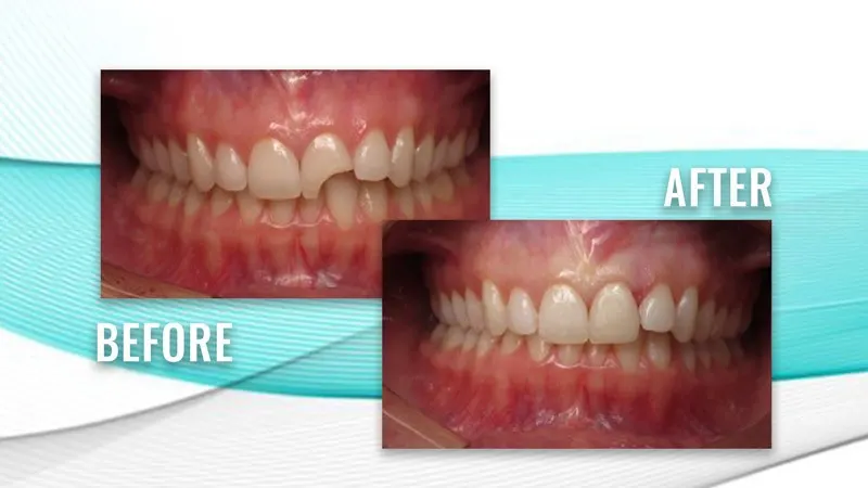 Before and after: a chipped upper front tooth, then a repaired, even front tooth