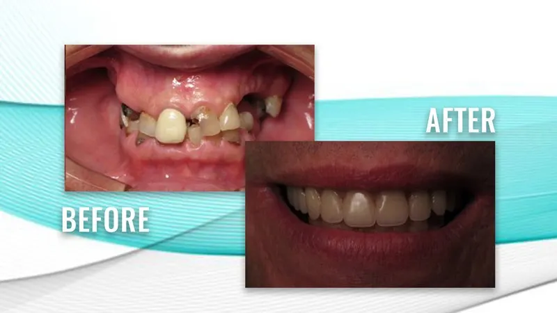 Before and after: broken and missing upper teeth, then a full, even smile