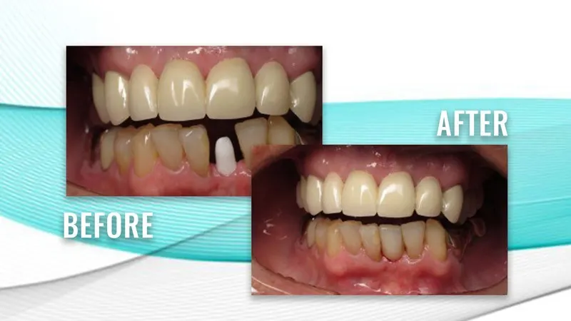 Before and after: worn teeth with a gap in the lower front row, then a filled lower row
