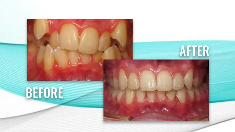 Before and after: crowded, overlapping upper teeth, then straight, aligned teeth