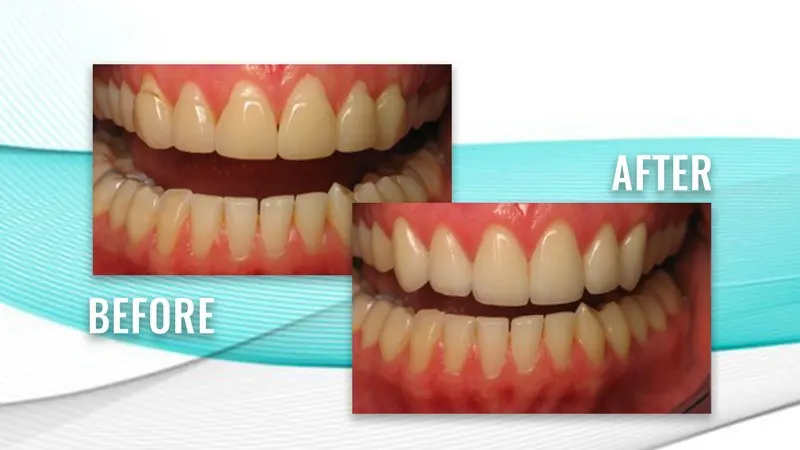 Before and after: slightly uneven upper and lower teeth, then a straighter, even bite