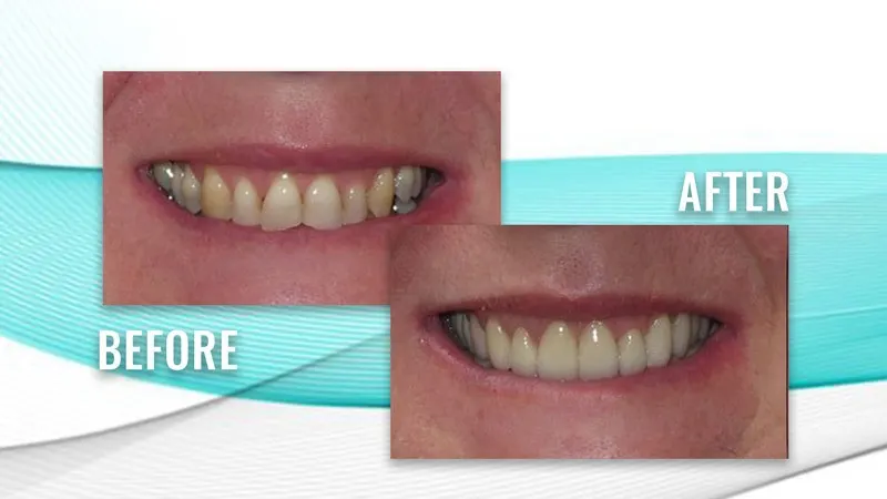 Before and after: a patient's smile with uneven, discolored teeth, then a uniform, brighter smile