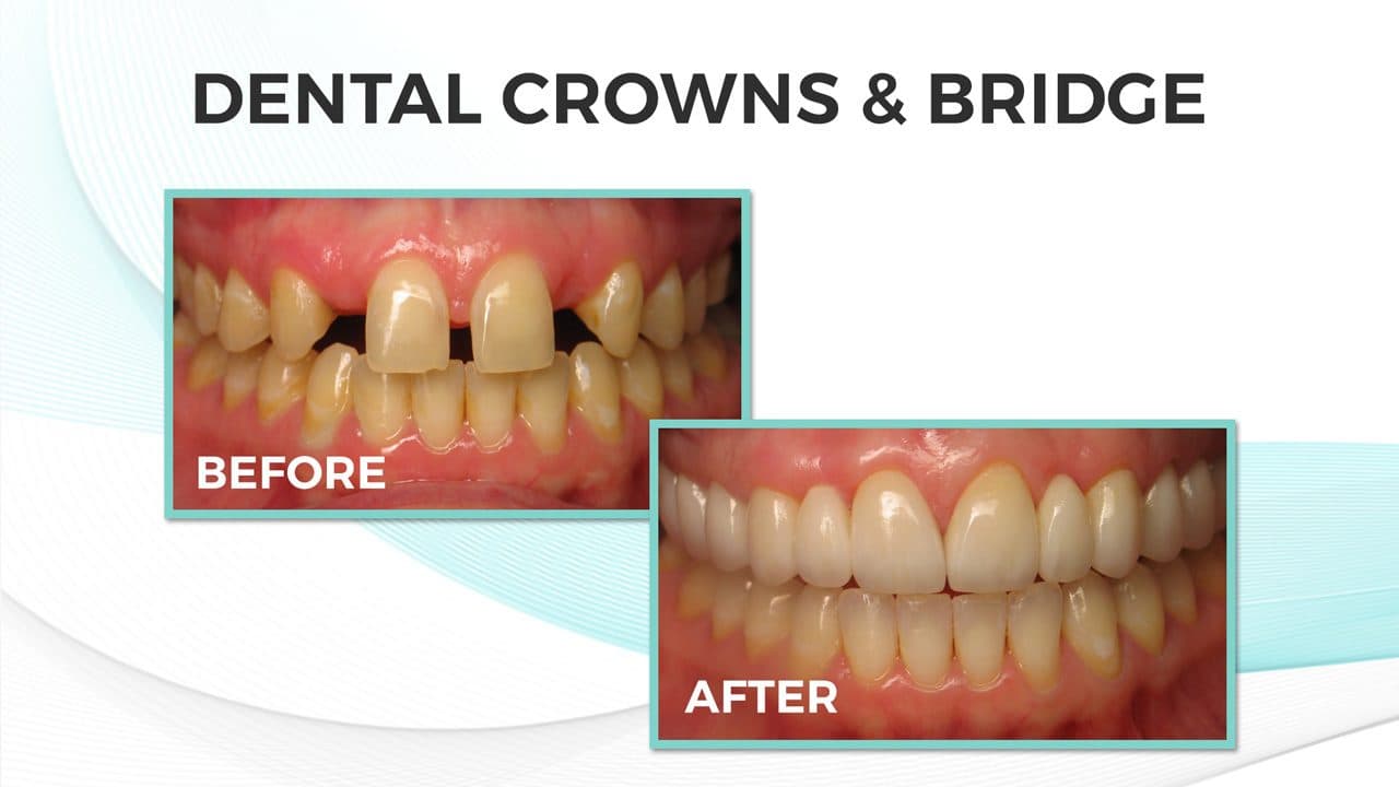 Before and after: a patient's upper teeth with wide gaps beside the front teeth, then a full, even row of upper teeth