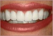 Teeth Whitening After